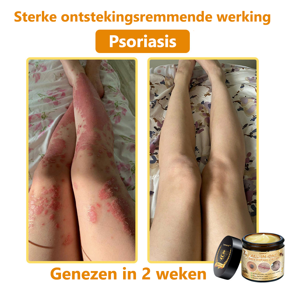 [Officiële merkwinkel] 💎 𝐋𝐞𝐧𝐚𝐫𝐨® Belgische Dermatologisch Gecertificeerde Bijengif Crème voor Alle Toepassingen （👩‍⚕️BSD Aanbevolen）