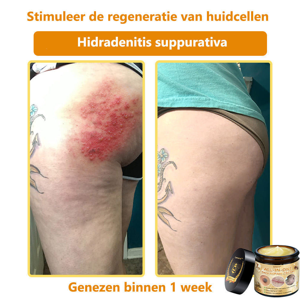 [Officiële merkwinkel]👑 𝐋𝐞𝐧𝐚𝐫𝐨® Belgische Dermatologisch Gecertificeerde Bijengif Crème voor Alle Toepassingen （👩‍⚕️BSD Aanbevolen）