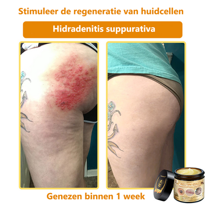 [Officiële merkwinkel] 💎 𝐋𝐞𝐧𝐚𝐫𝐨® Belgische Dermatologisch Gecertificeerde Bijengif Crème voor Alle Toepassingen （👩‍⚕️BSD Aanbevolen）