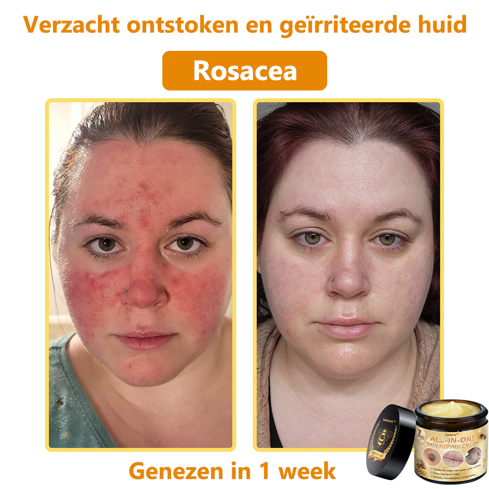 [Officiële merkwinkel] 💎 𝐋𝐞𝐧𝐚𝐫𝐨® Belgische Dermatologisch Gecertificeerde Bijengif Crème voor Alle Toepassingen （👩‍⚕️BSD Aanbevolen）